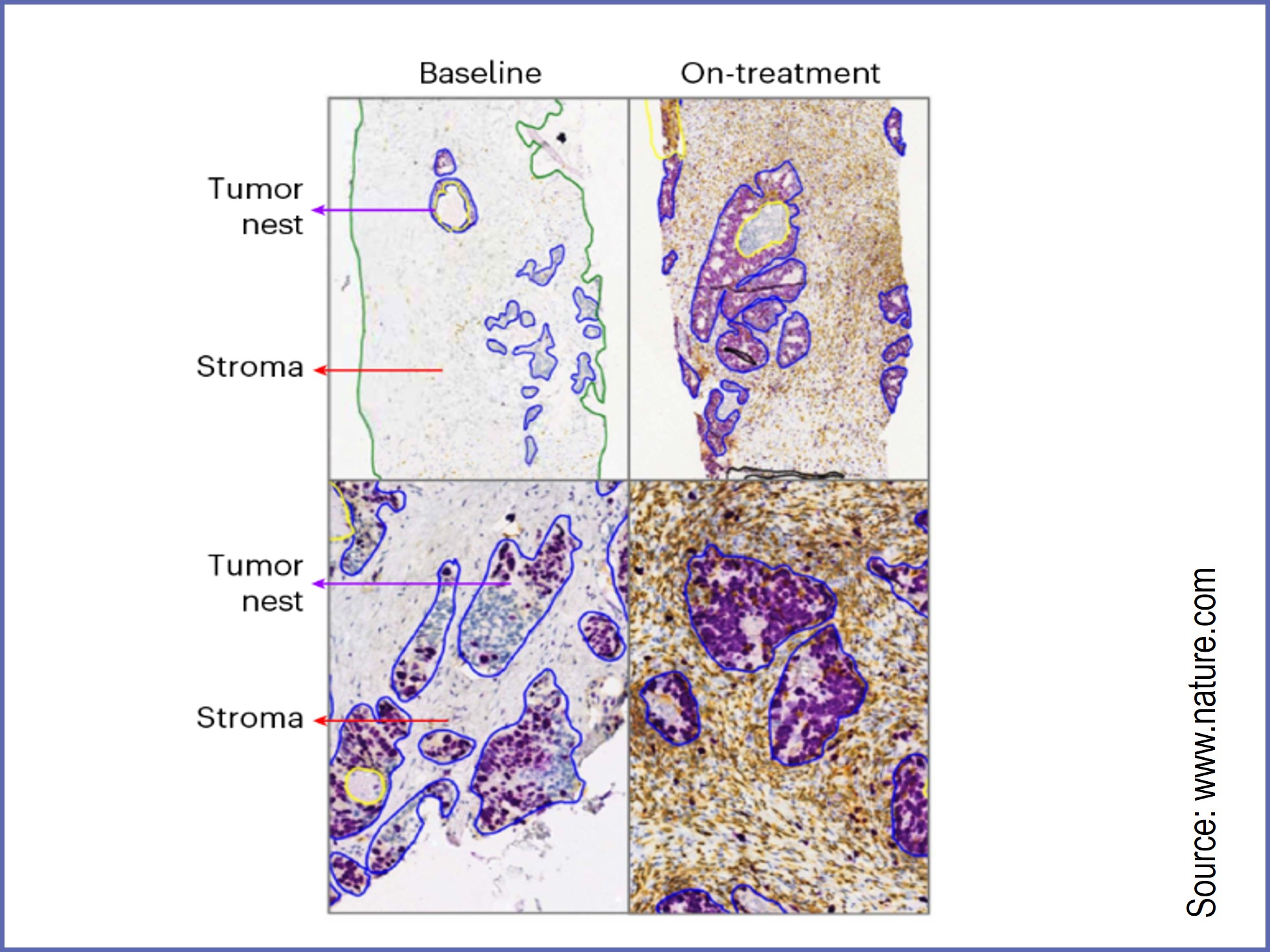 Cibisatamab and FAP-4-1BBL in microsatellite-stable metastatic colorectal cancer